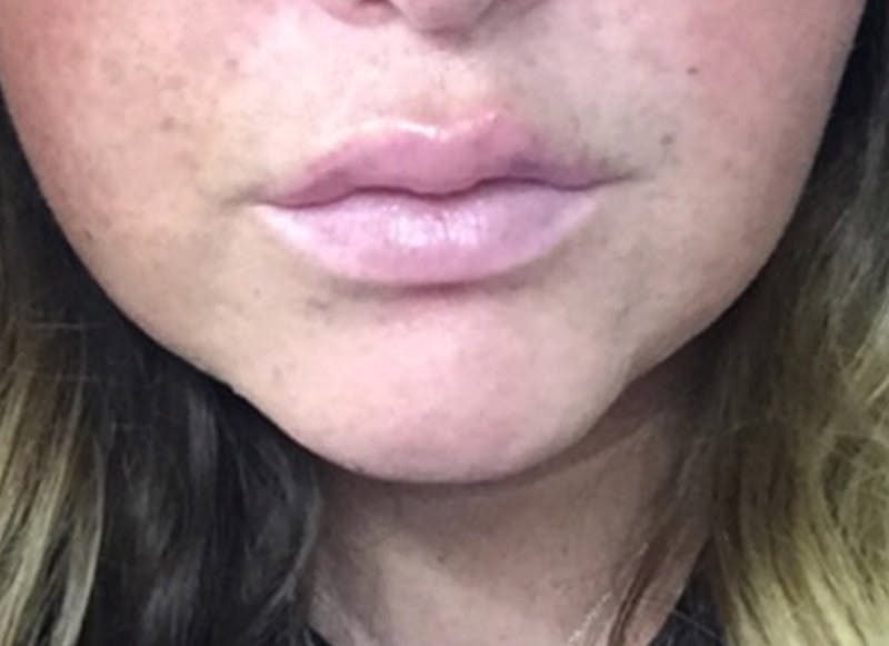 Fillers Before & After Gallery - Patient 112338698 - Image 2