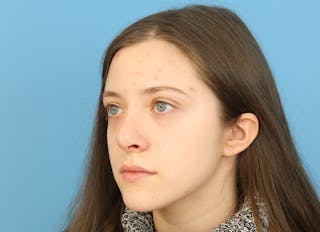 Rhinoplasty Before & After Gallery - Patient 112338704 - Image 4