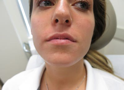 Fillers Before & After Gallery - Patient 112338700 - Image 1