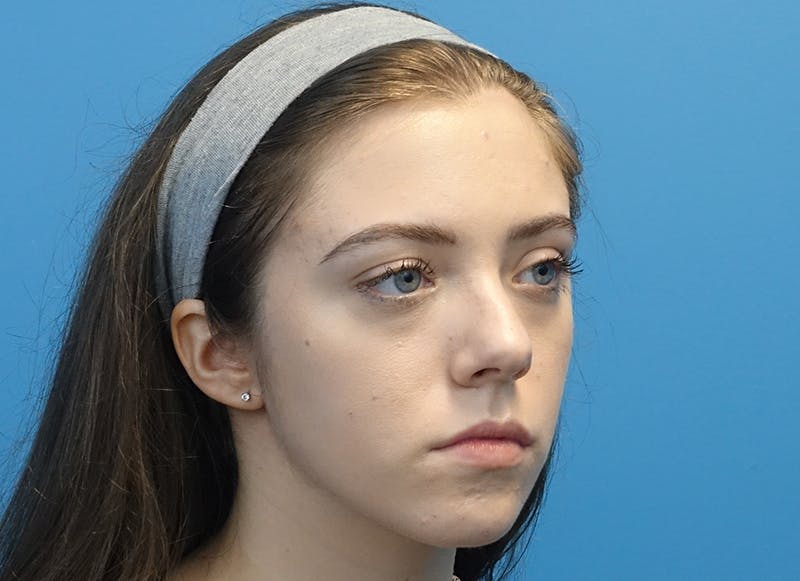 Rhinoplasty Before & After Gallery - Patient 112338704 - Image 7