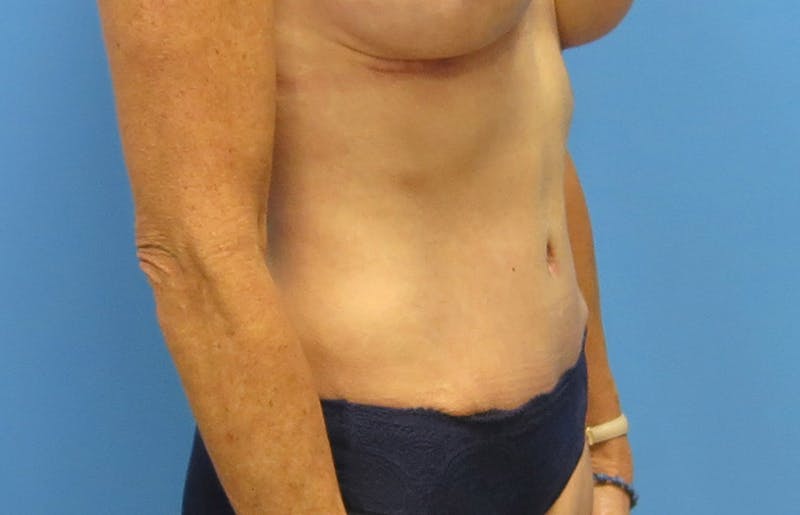 Abdominoplasty Before & After Gallery - Patient 112338707 - Image 8