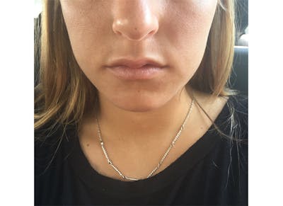 Fillers Before & After Gallery - Patient 112338700 - Image 2