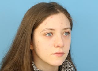 Rhinoplasty Before & After Gallery - Patient 112338704 - Image 8