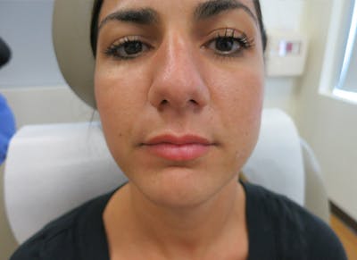 Fillers Before & After Gallery - Patient 112338703 - Image 1