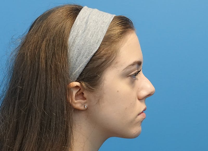 Rhinoplasty Before & After Gallery - Patient 112338704 - Image 9