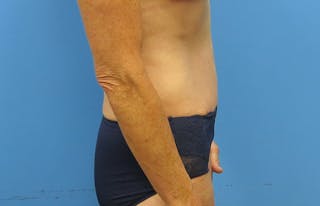 Abdominoplasty Before & After Gallery - Patient 112338707 - Image 10