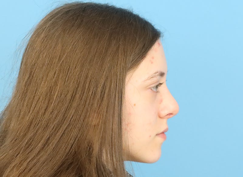 Rhinoplasty Before & After Gallery - Patient 112338704 - Image 10
