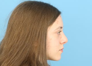 Rhinoplasty Before & After Gallery - Patient 112338704 - Image 10