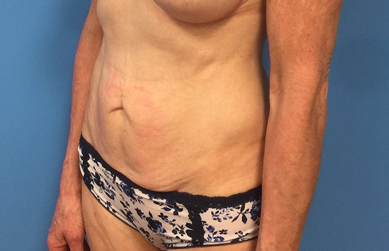 Abdominoplasty Before & After Gallery - Patient 112338707 - Image 3