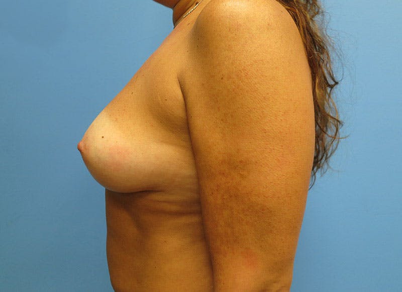 Augmentation Before & After Gallery - Patient 112338706 - Image 1