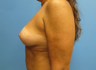 Augmentation Before & After Gallery - Patient 112338706 - Image 1