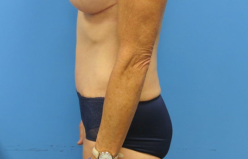 Abdominoplasty Before & After Gallery - Patient 112338707 - Image 2
