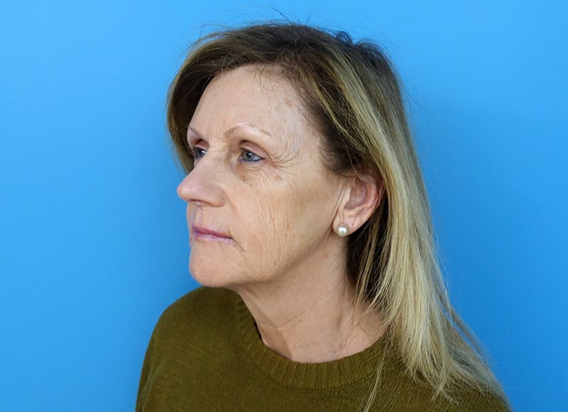 Fillers Before & After Gallery - Patient 112338716 - Image 3