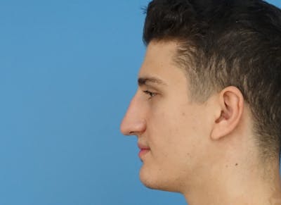 Rhinoplasty Before & After Gallery - Patient 112338715 - Image 1