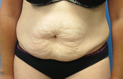Abdominoplasty Before & After Gallery - Patient 112338717 - Image 5