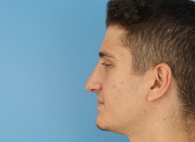 Rhinoplasty Before & After Gallery - Patient 112338715 - Image 2