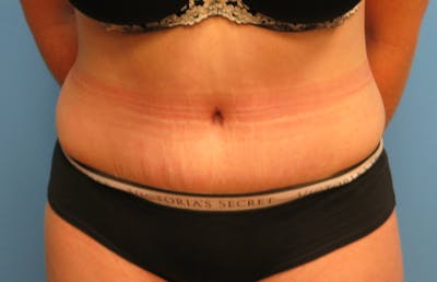 Abdominoplasty Before & After Gallery - Patient 112338717 - Image 6