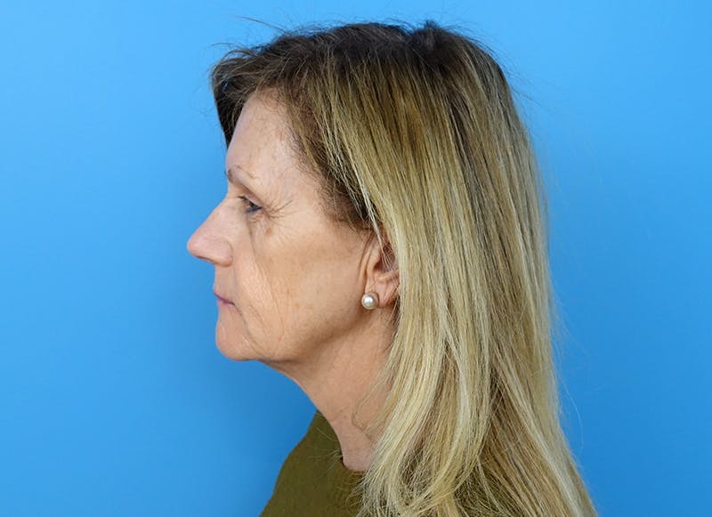 Fillers Before & After Gallery - Patient 112338716 - Image 1