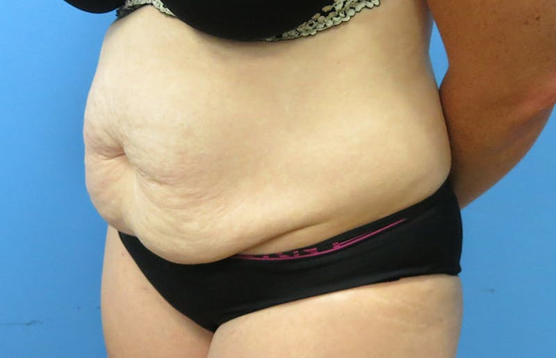 Abdominoplasty Before & After Gallery - Patient 112338717 - Image 3