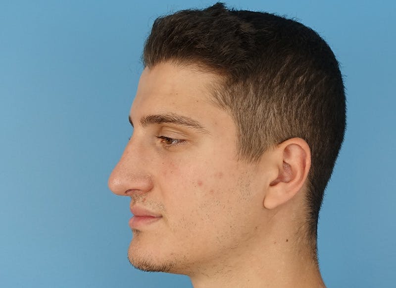 Rhinoplasty Before & After Gallery - Patient 112338715 - Image 4
