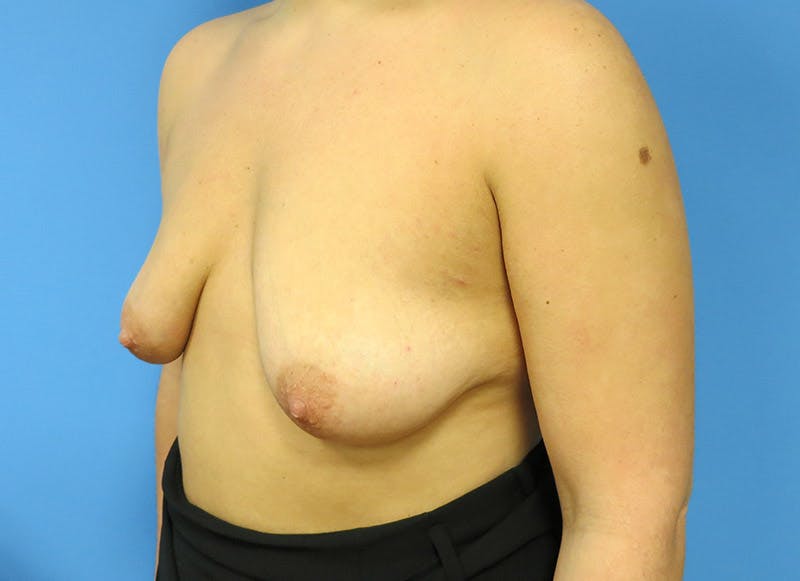 Augmentation Before & After Gallery - Patient 112338718 - Image 3