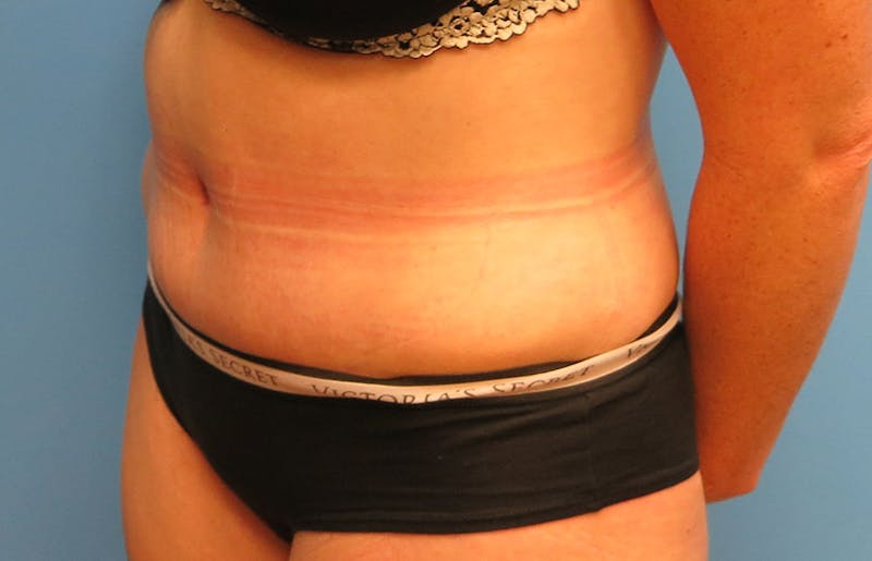 Abdominoplasty Before & After Gallery - Patient 112338717 - Image 4