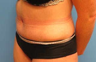 Abdominoplasty Before & After Gallery - Patient 112338717 - Image 4