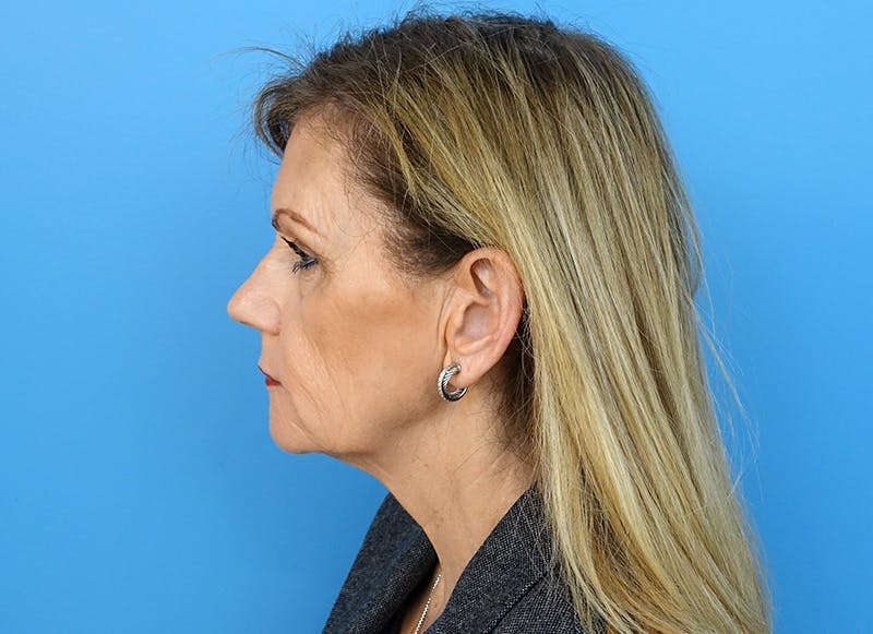 Fillers Before & After Gallery - Patient 112338716 - Image 2