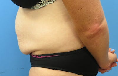 Abdominoplasty Before & After Gallery - Patient 112338717 - Image 1