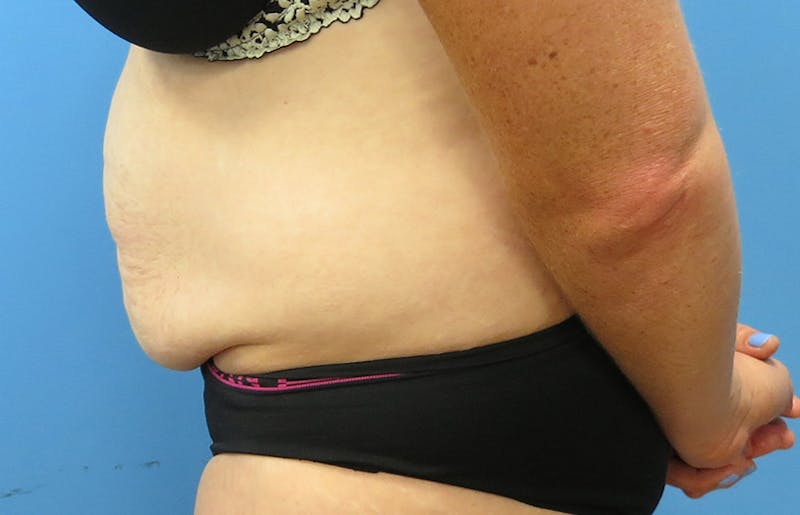 Abdominoplasty Before & After Gallery - Patient 112338717 - Image 1