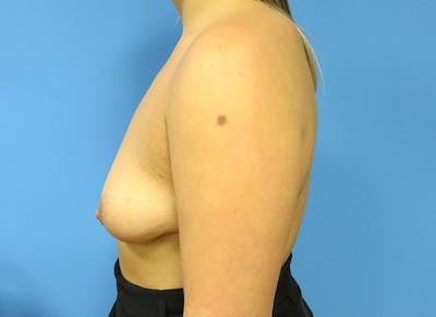 Augmentation Before & After Gallery - Patient 112338718 - Image 1