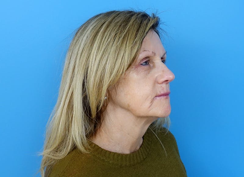 Fillers Before & After Gallery - Patient 112338716 - Image 7