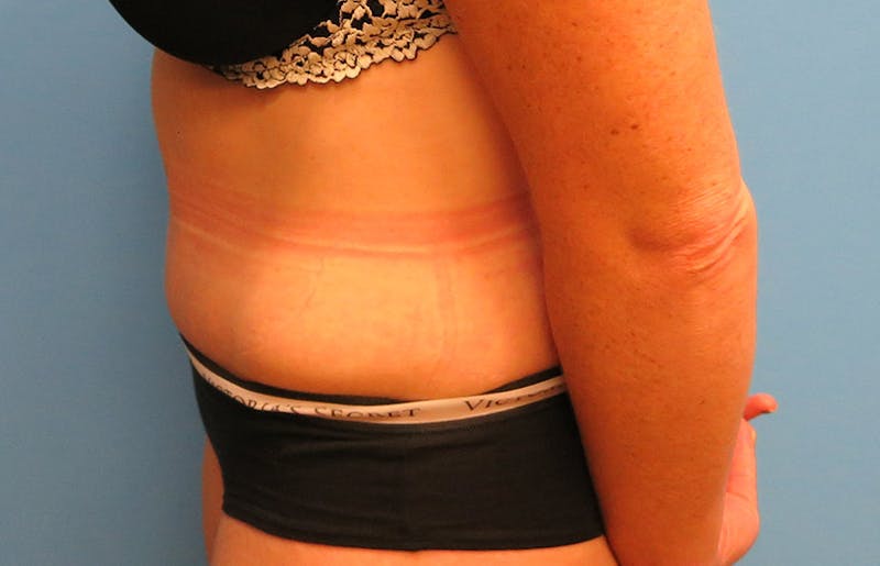 Abdominoplasty Before & After Gallery - Patient 112338717 - Image 2