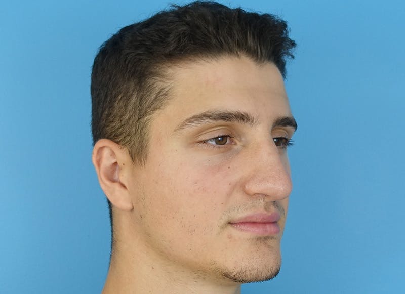 Rhinoplasty Before & After Gallery - Patient 112338715 - Image 8