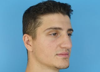 Rhinoplasty Before & After Gallery - Patient 112338715 - Image 8