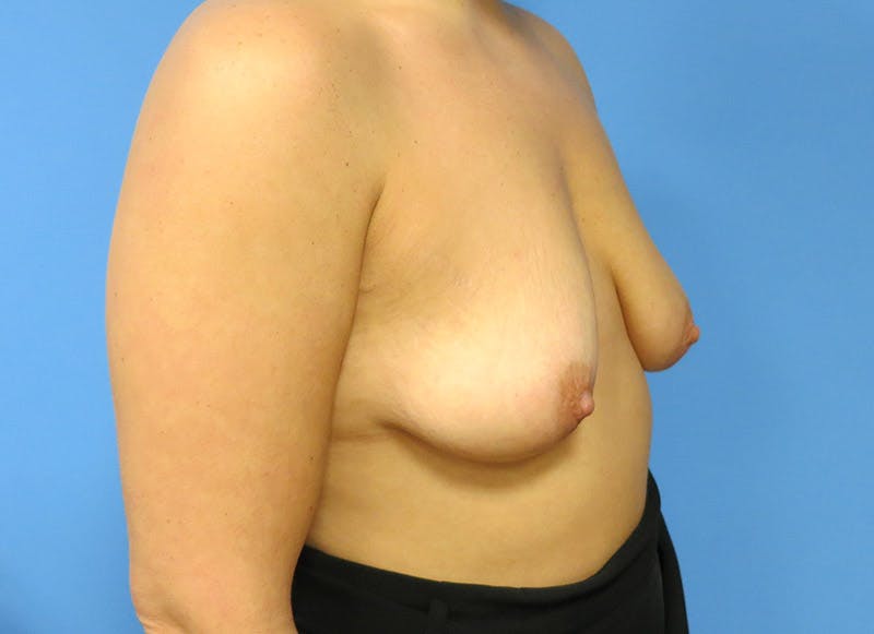 Augmentation Before & After Gallery - Patient 112338718 - Image 7