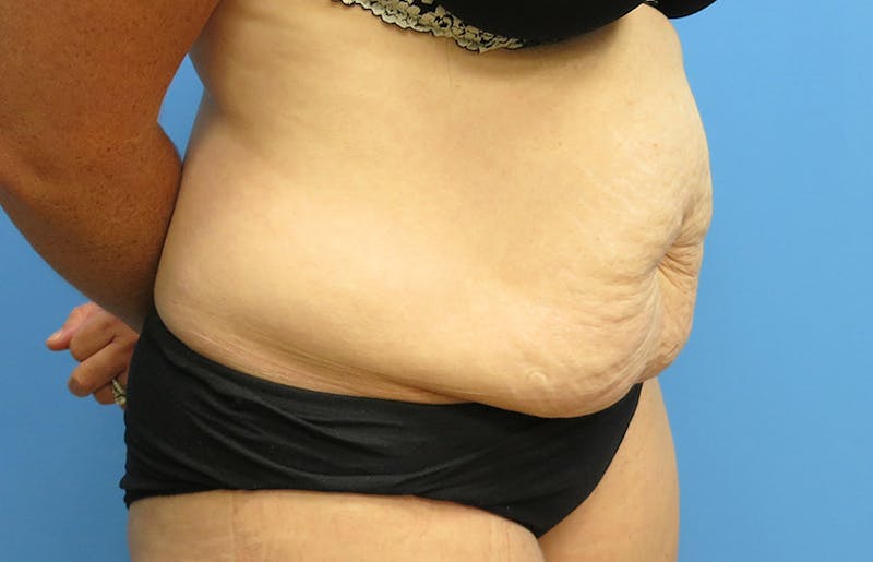Abdominoplasty Before & After Gallery - Patient 112338717 - Image 7