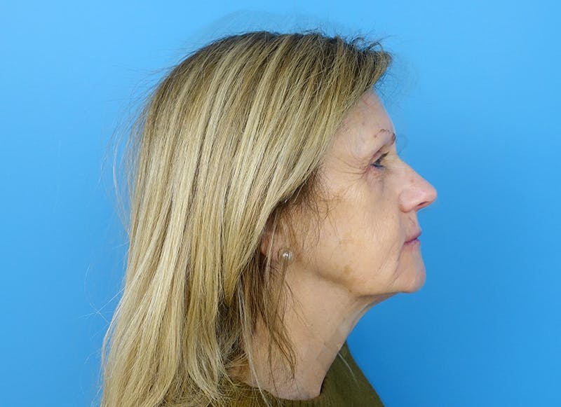 Fillers Before & After Gallery - Patient 112338716 - Image 9