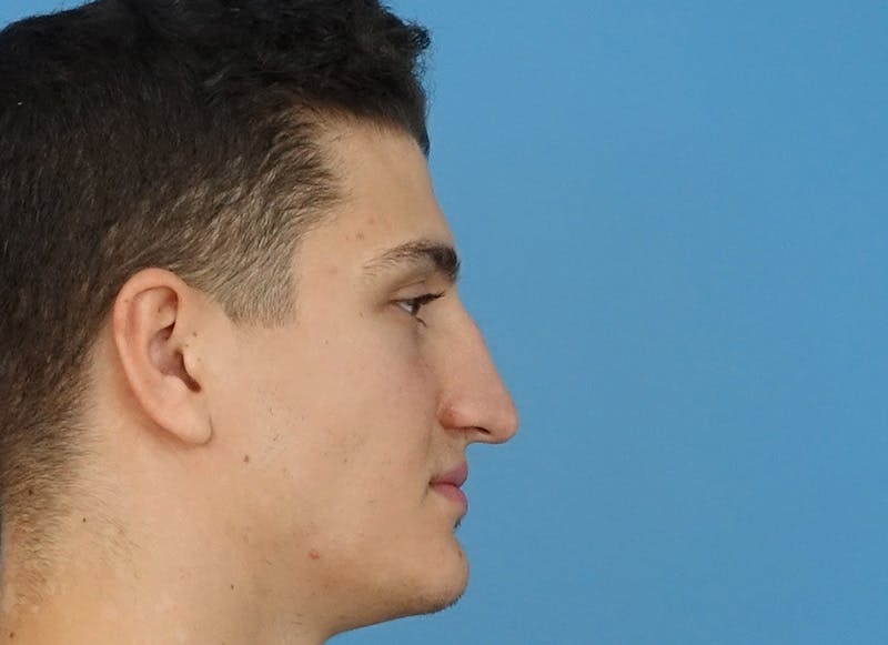Rhinoplasty Before & After Gallery - Patient 112338715 - Image 9