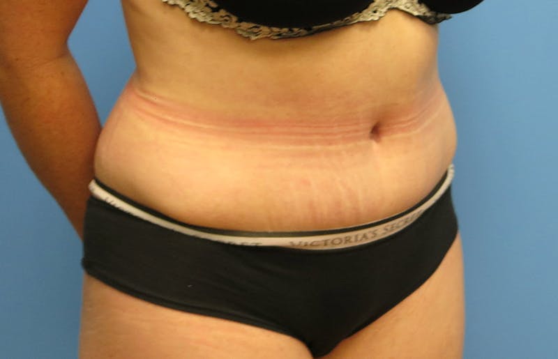 Abdominoplasty Before & After Gallery - Patient 112338717 - Image 8