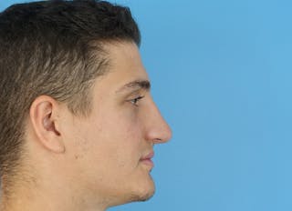 Rhinoplasty Before & After Gallery - Patient 112338715 - Image 10