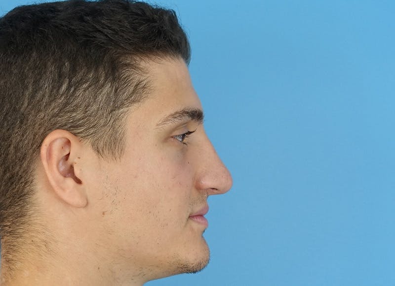Rhinoplasty Before & After Gallery - Patient 112338715 - Image 10