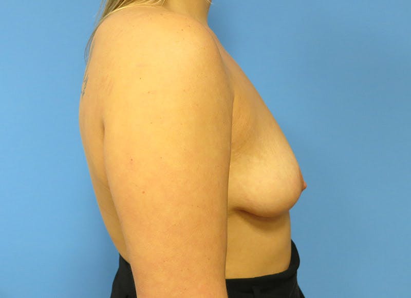 Augmentation Before & After Gallery - Patient 112338718 - Image 9