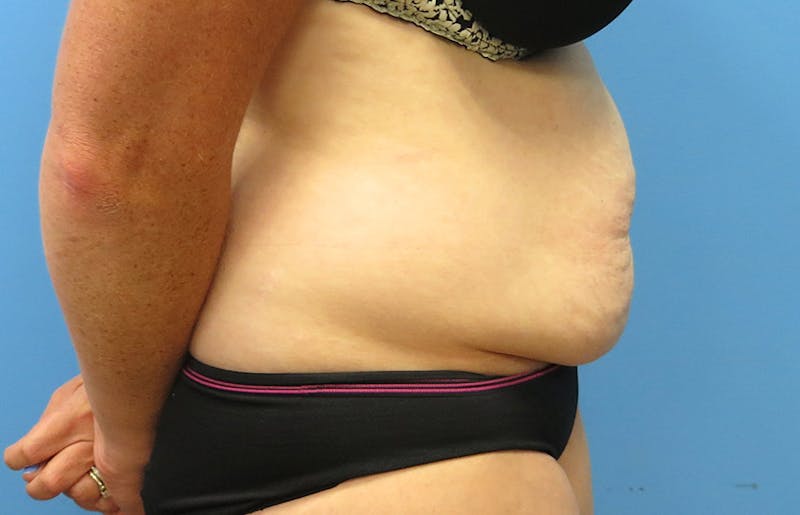 Abdominoplasty Before & After Gallery - Patient 112338717 - Image 9