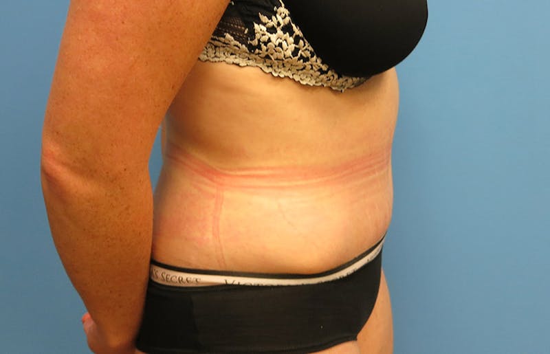Abdominoplasty Before & After Gallery - Patient 112338717 - Image 10