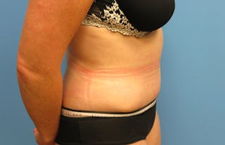 Abdominoplasty Before & After Gallery - Patient 112338717 - Image 10