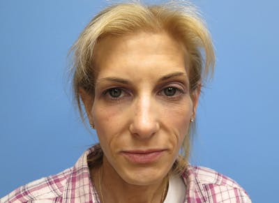 Fillers Before & After Gallery - Patient 112338723 - Image 5