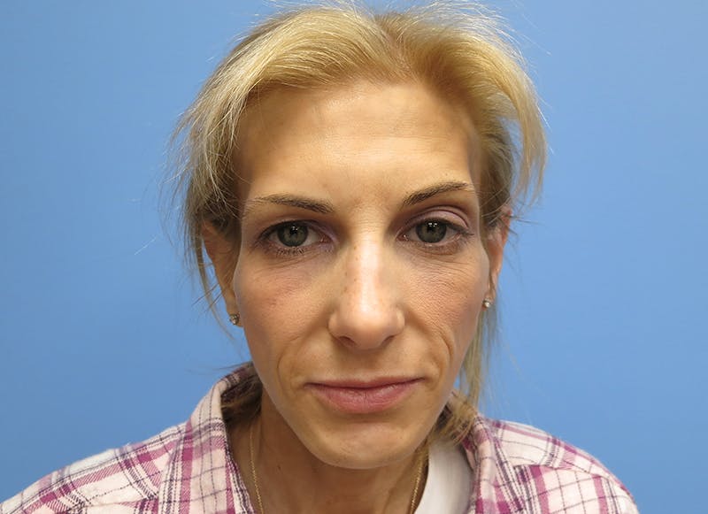 Fillers Before & After Gallery - Patient 112338723 - Image 5