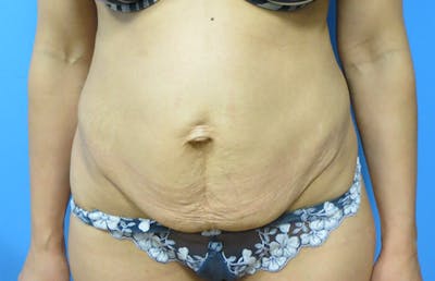 Abdominoplasty Before & After Gallery - Patient 112338722 - Image 5
