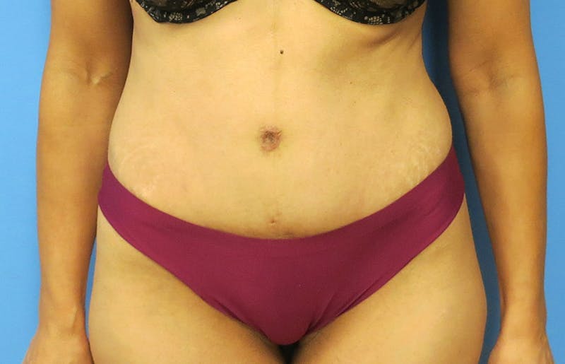 Abdominoplasty Before & After Gallery - Patient 112338722 - Image 6